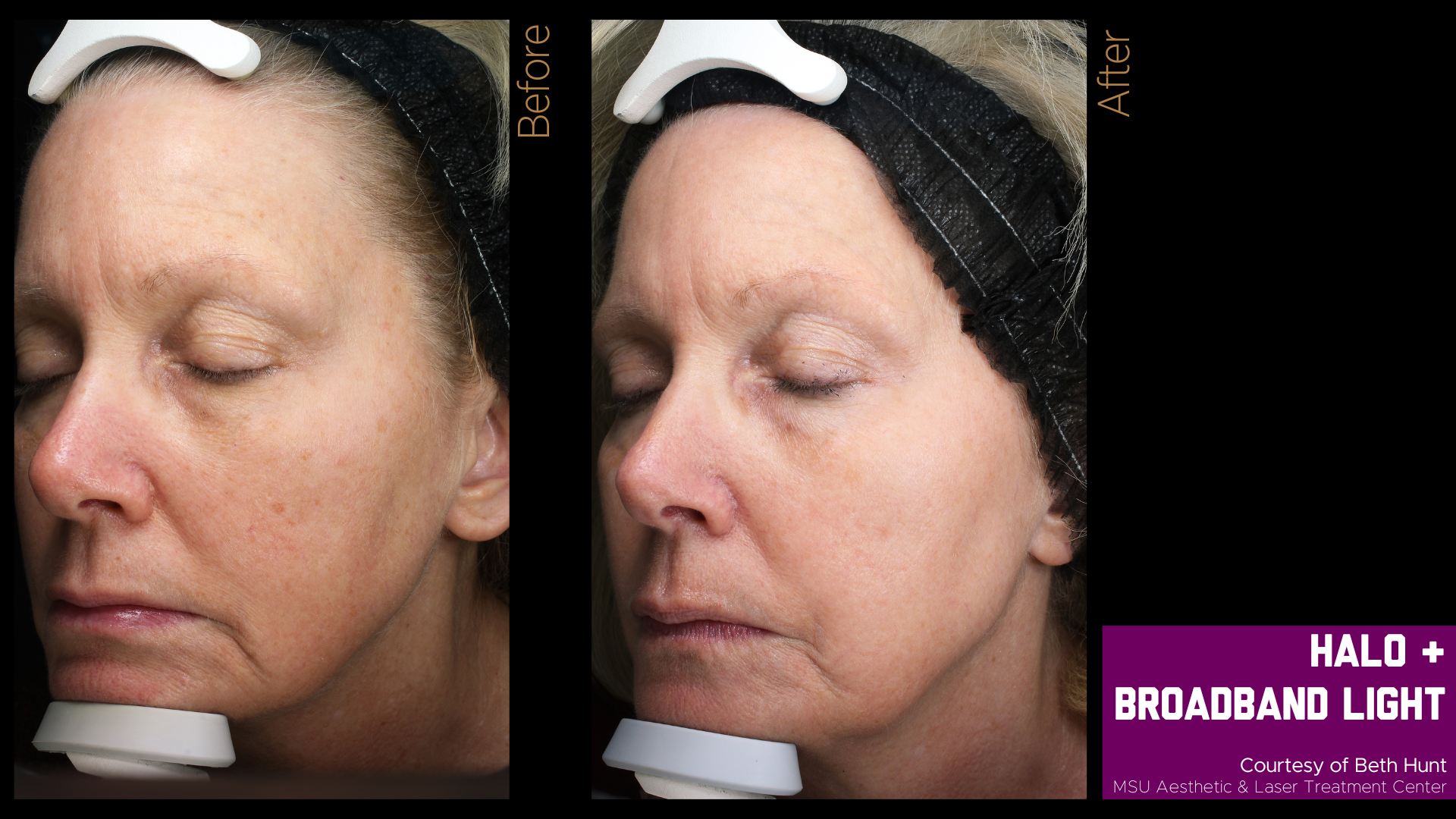 before and after halo treatment results