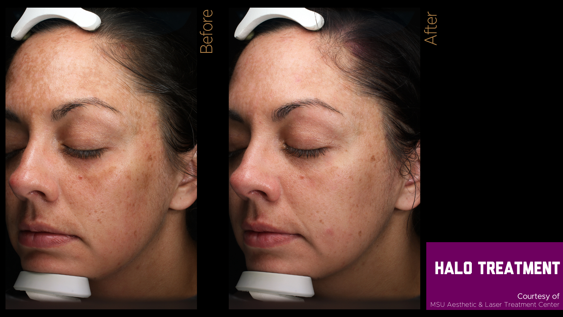before and after halo treatment results