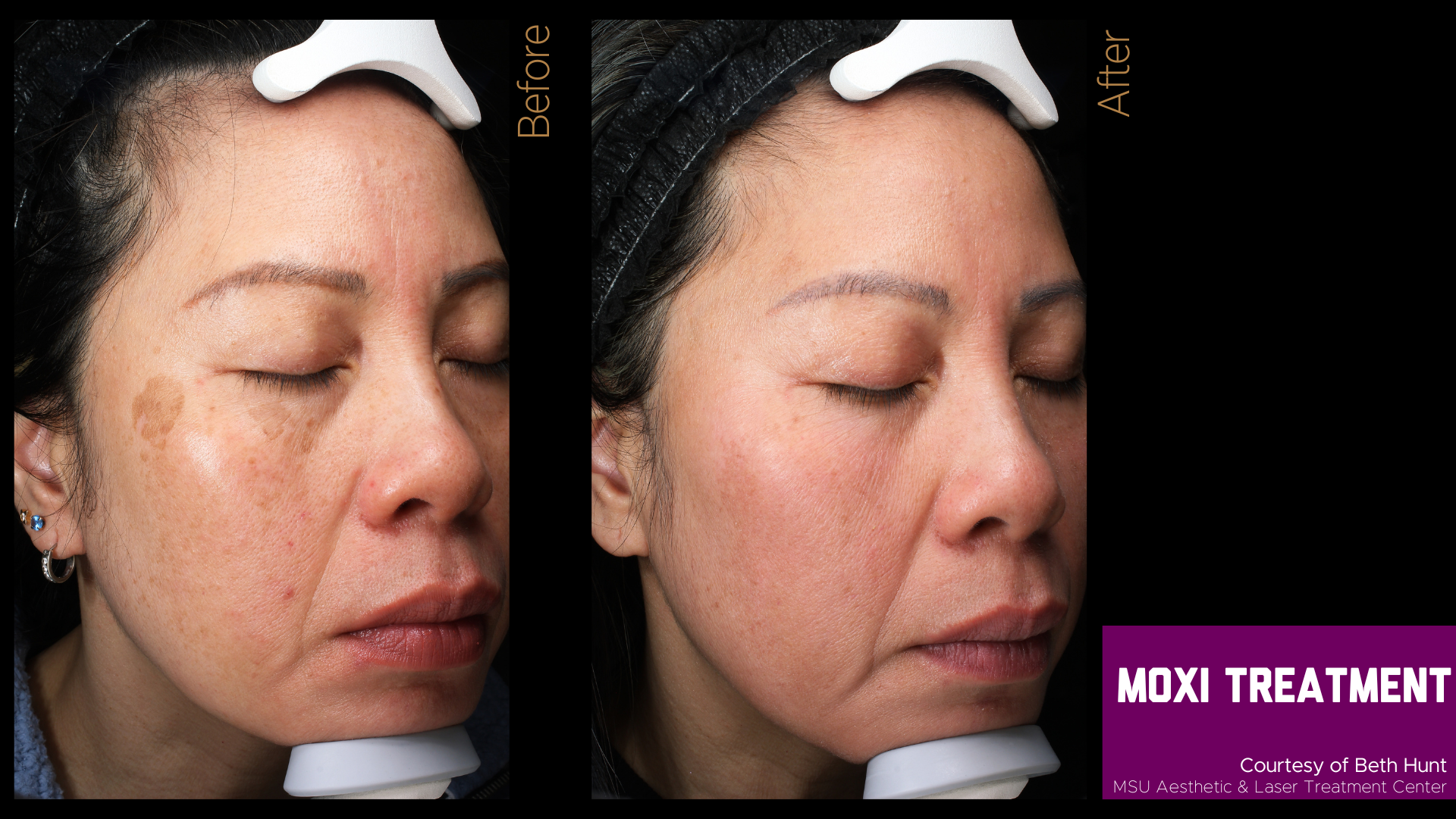 before and after of a moxi treatment