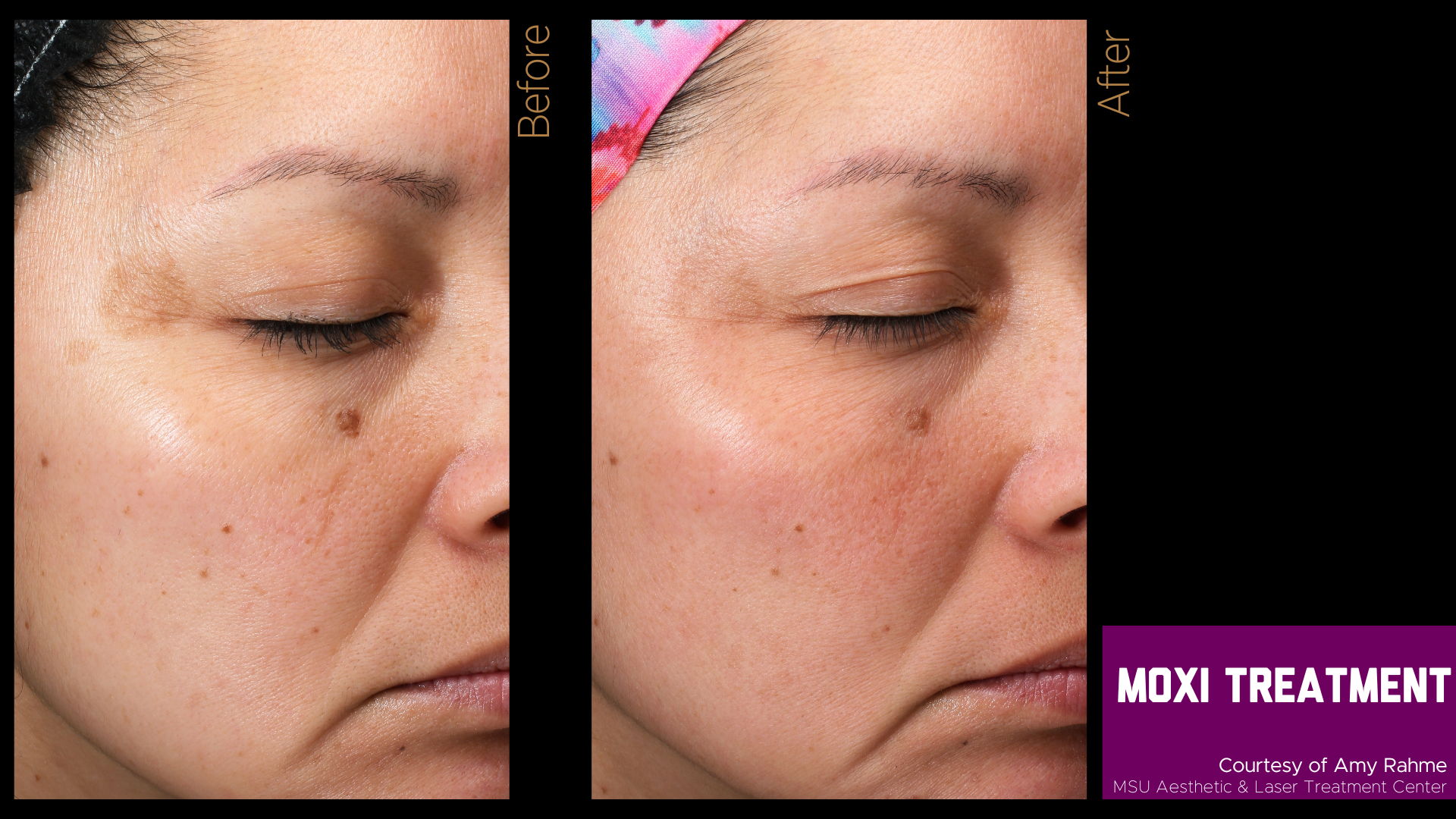 before and after of a moxi treatment