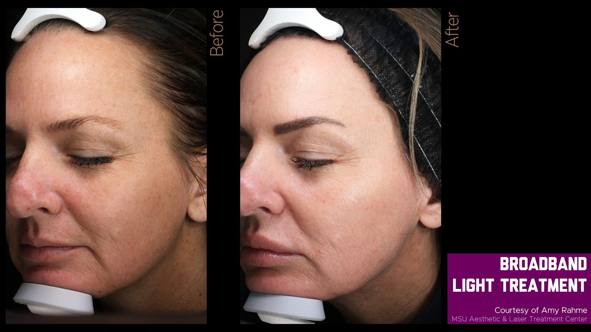 before and after photos of a broadband light treatment