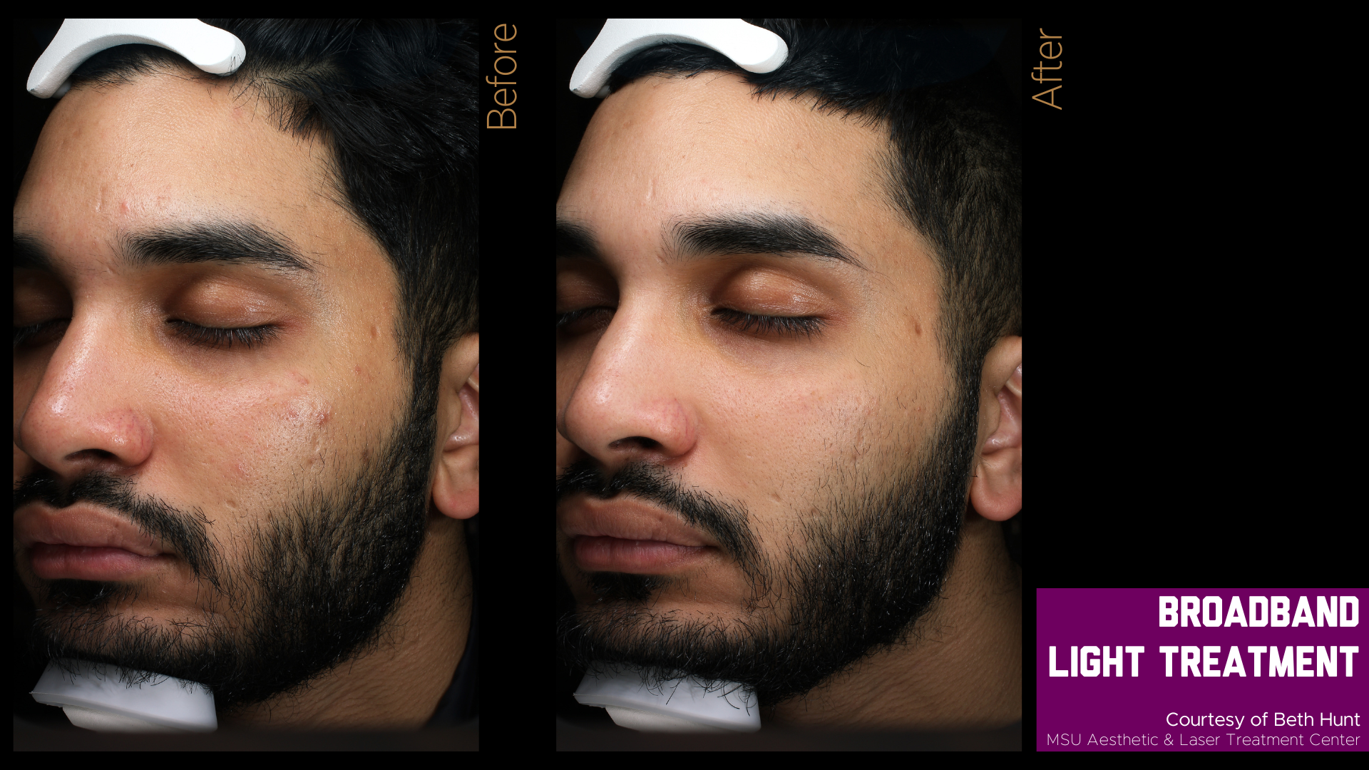 before and after photos of a broadband light treatment